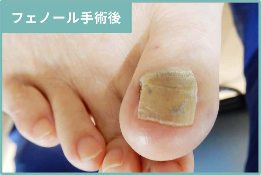 フェノール手術後
