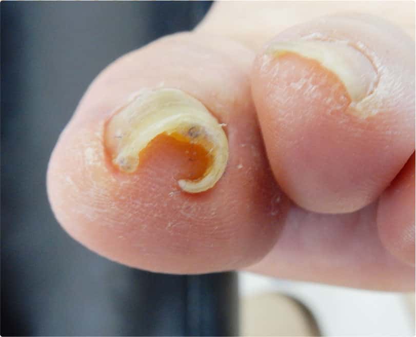 陥入爪