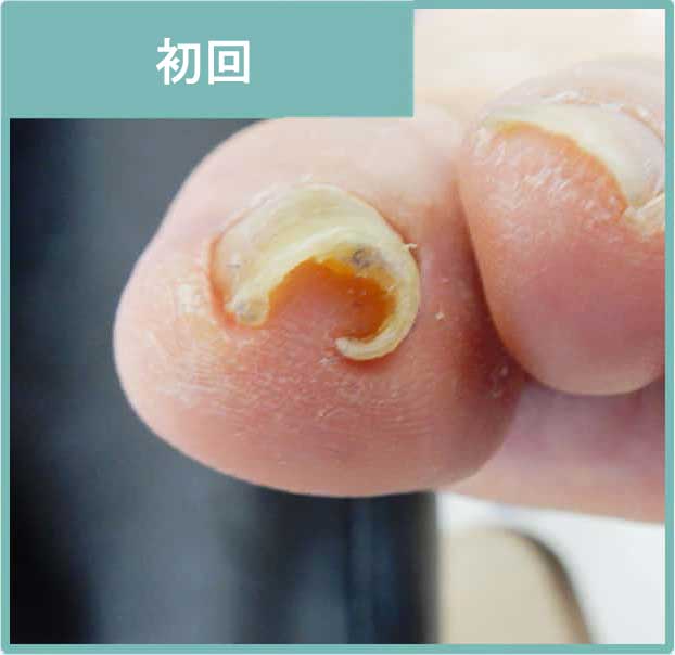 初回施術後