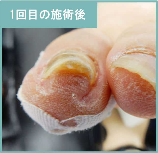 2回目施術後