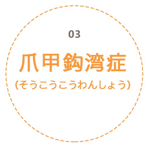 爪甲鈎湾症